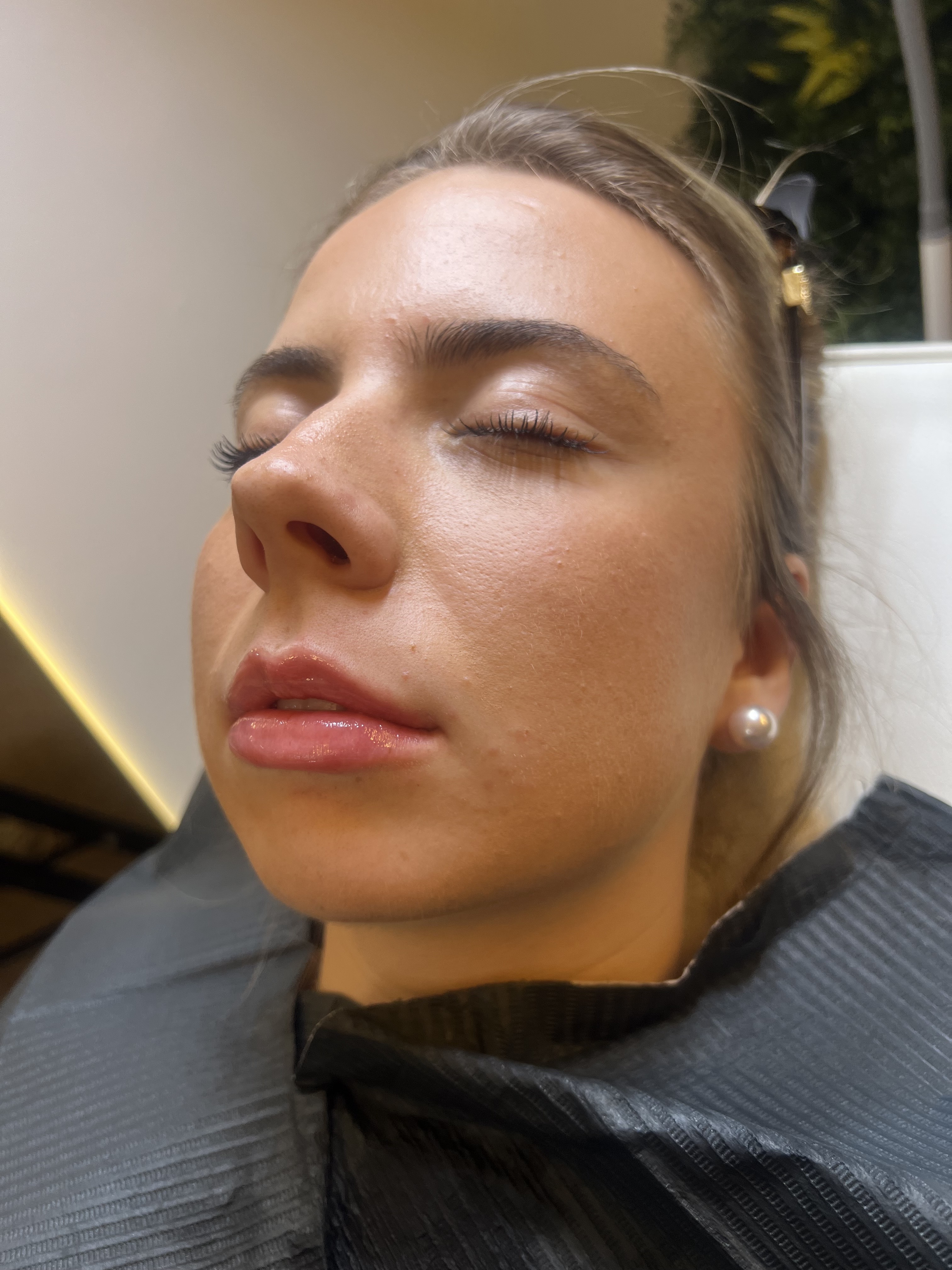 After lip filler treatment