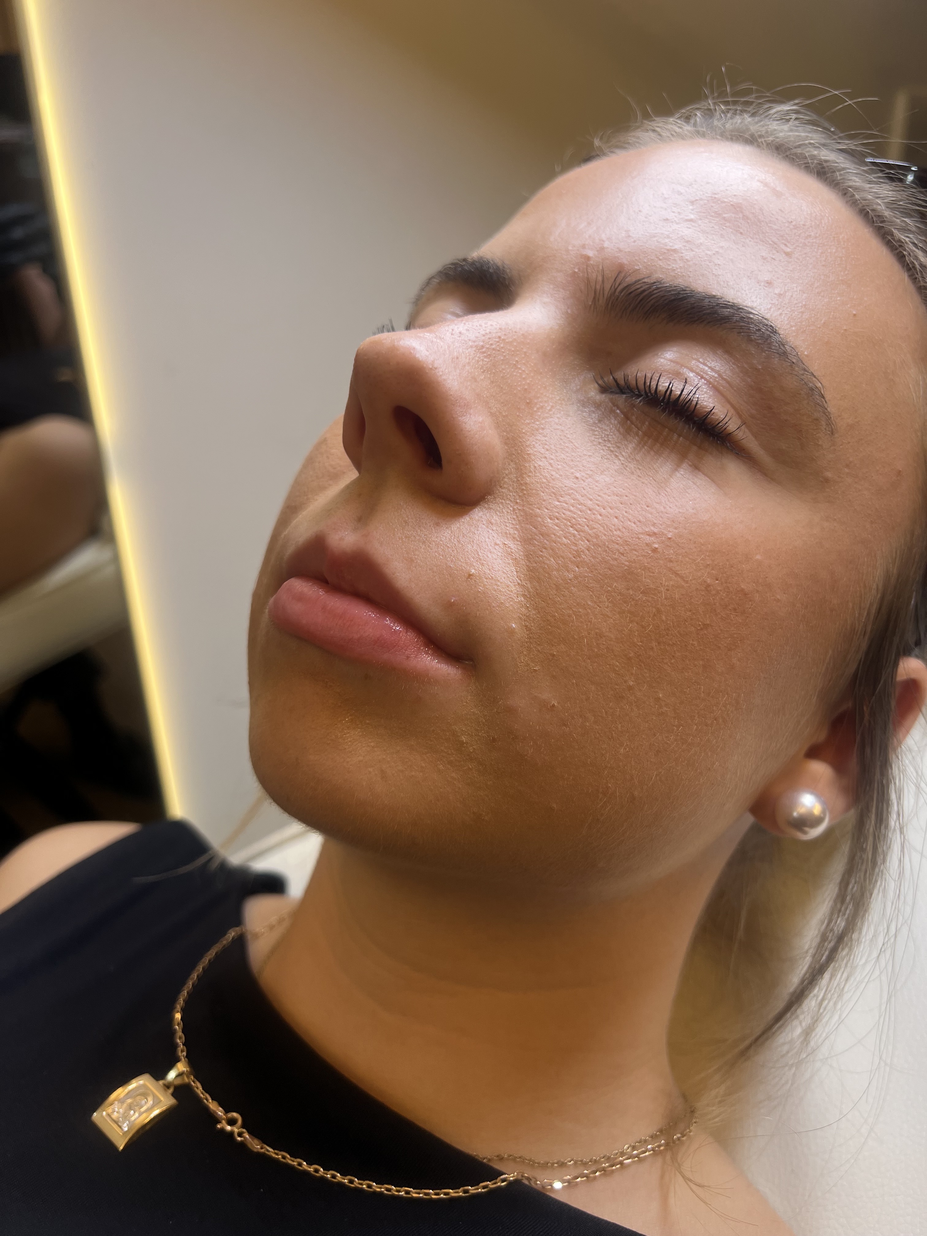 Before lip filler treatment