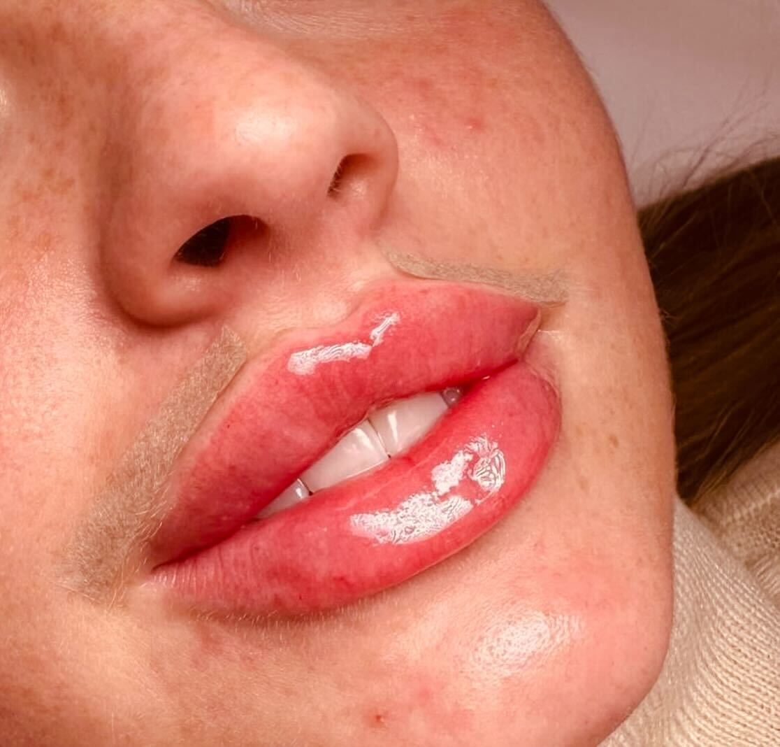 After Russian lips treatment