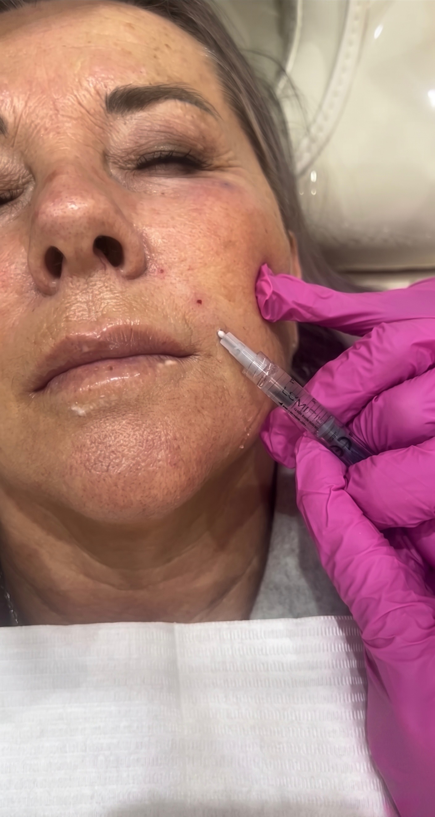 After smile lines treatment