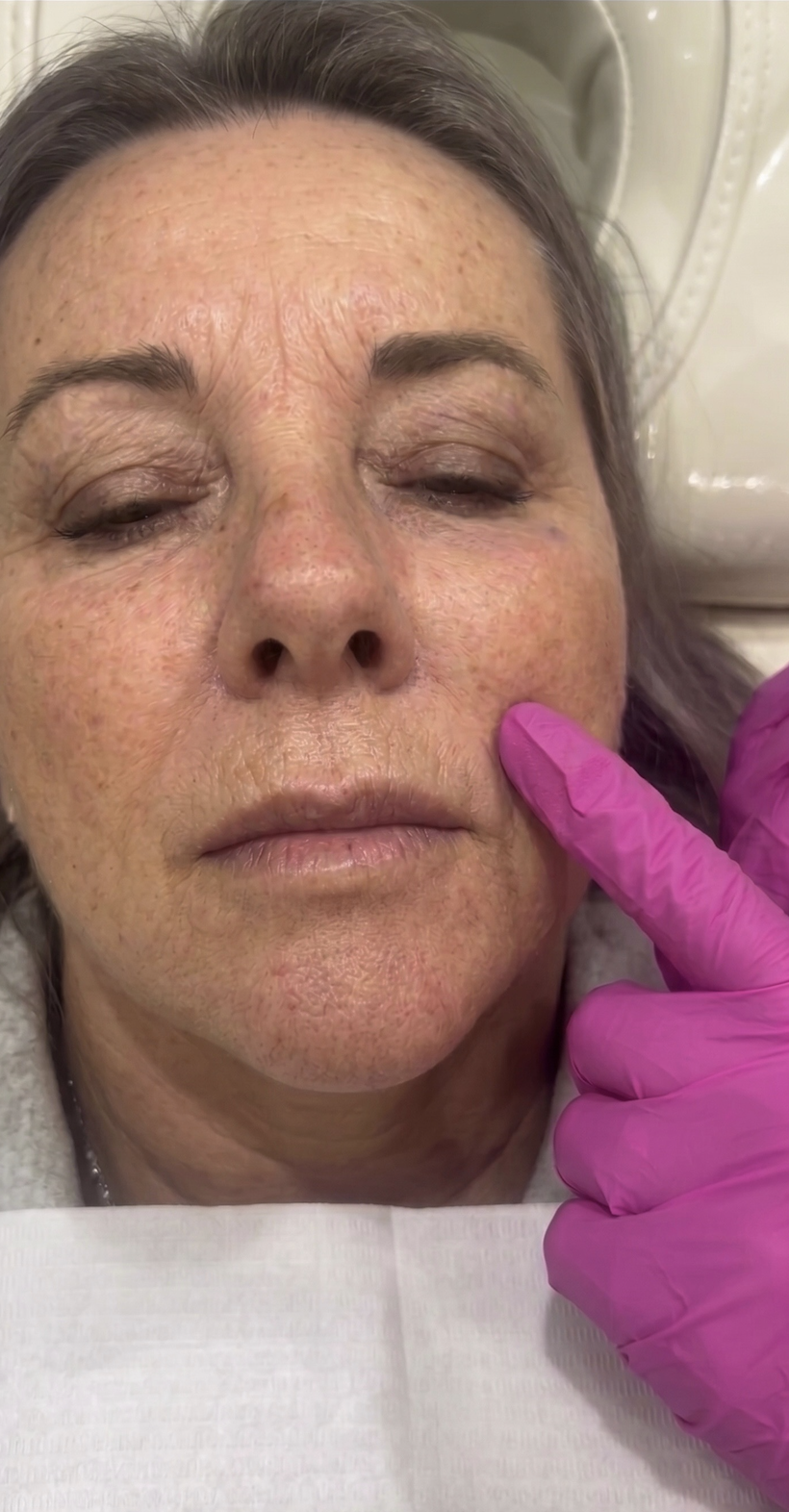 Before smile lines treatment