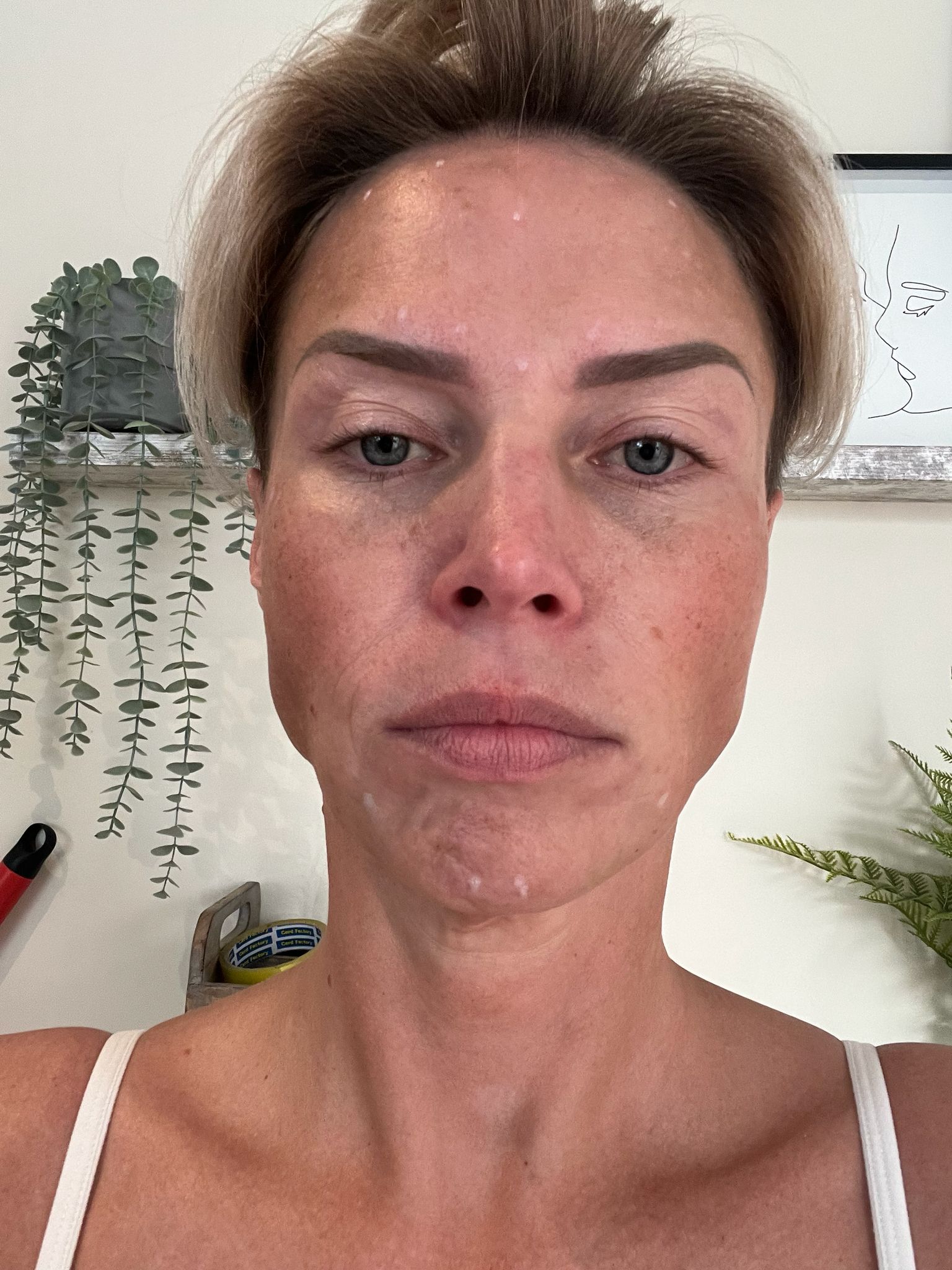 After anti-wrinkle injections