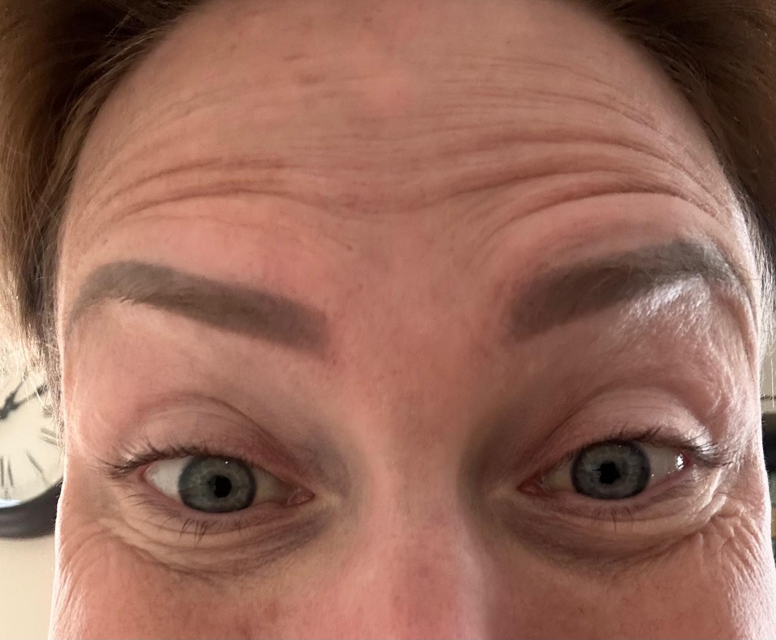 Before anti-wrinkle injections